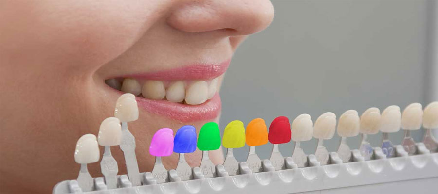 Tooth-Coloured-Fillings