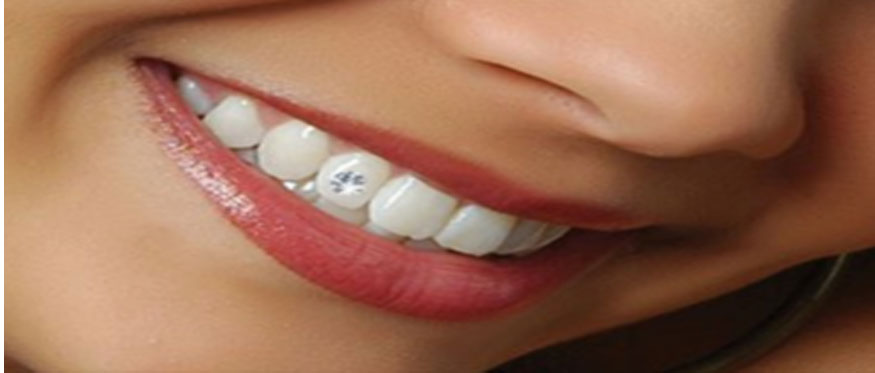 dental-jewellery